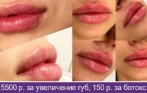 Всего 5500 р. за увеличение губ, 150 р. за ботокс, 199 за мезонити, лазерная эпиляция в «Академии красоты»!