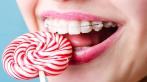 Установка металлической, сапфировой, невидимой брекет-системы Damon Clear, Damon Q, American Orthodontics.