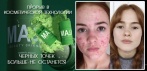 На Green Acne Stick средство для очистки пор. Мягкая и безопасная очистка пор!